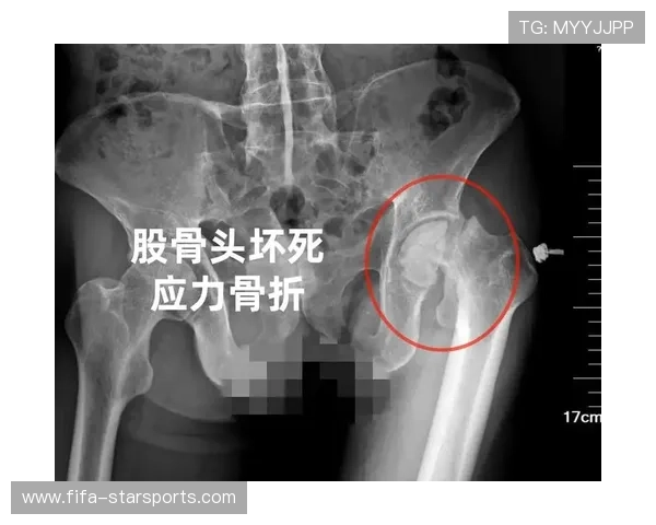 应力性骨折:疲劳积累到骨头都撑不住,应力性骨折是什么意思 应力性骨折:疲劳积累到骨头都撑不住,应力性骨折是什么意思